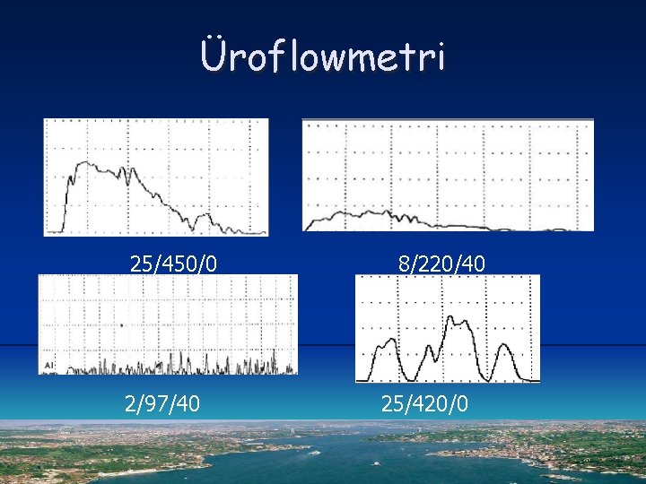 Üroflowmetri 25/450/0 2/97/40 8/220/40 25/420/0 
