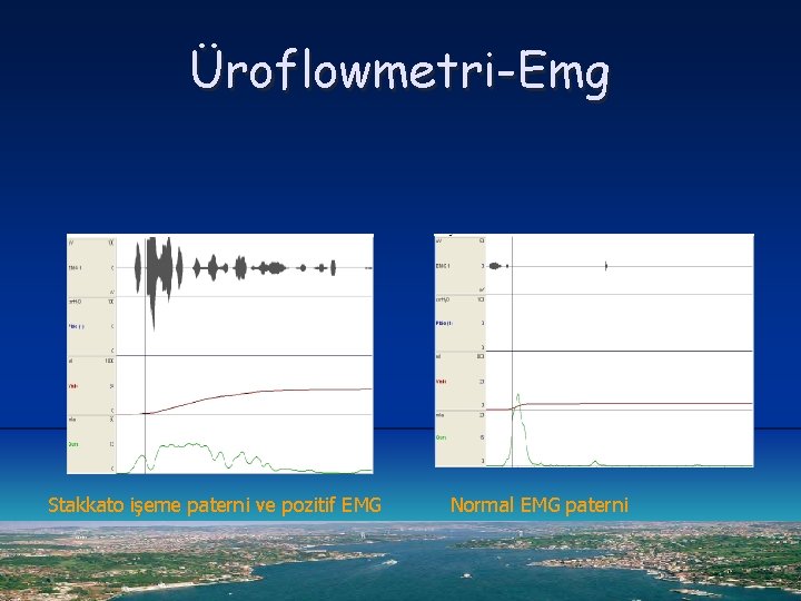 Üroflowmetri-Emg Stakkato işeme paterni ve pozitif EMG Normal EMG paterni 