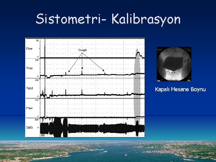 Sistometri- Kalibrasyon Kapalı Mesane Boynu 
