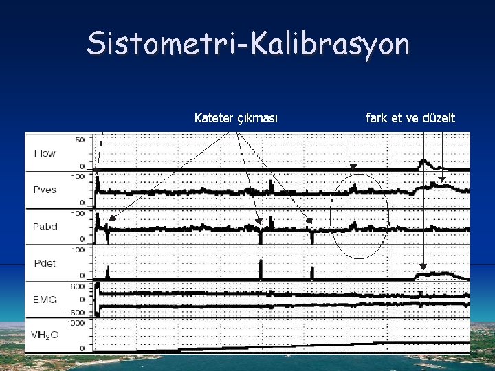 Sistometri-Kalibrasyon Kateter çıkması fark et ve düzelt 