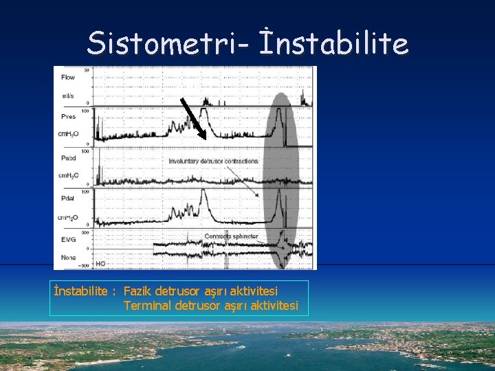 Sistometri- İnstabilite d. LPP İnstabilite : Fazik detrusor aşırı aktivitesi Terminal detrusor aşırı aktivitesi