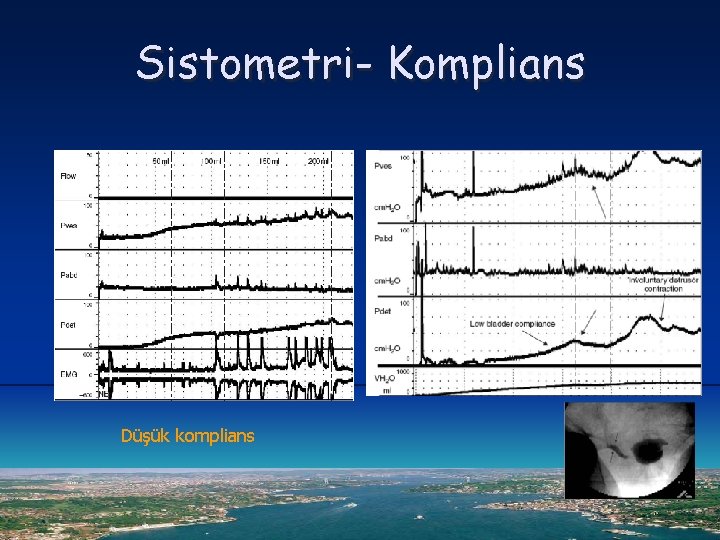 Sistometri- Komplians Düşük komplians 