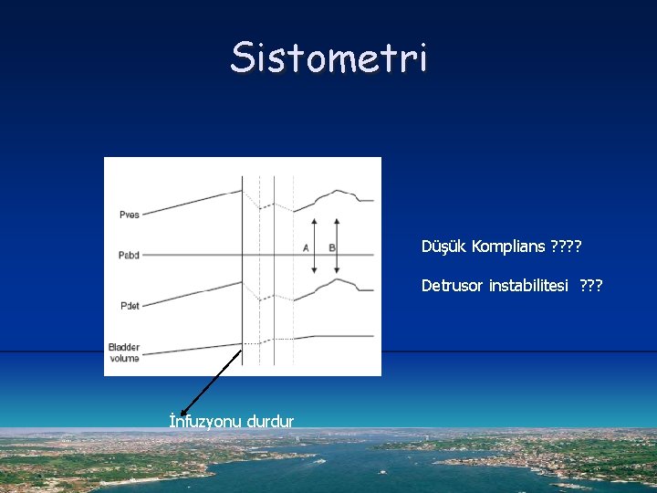 Sistometri Düşük Komplians ? ? Detrusor instabilitesi ? ? ? İnfuzyonu durdur 