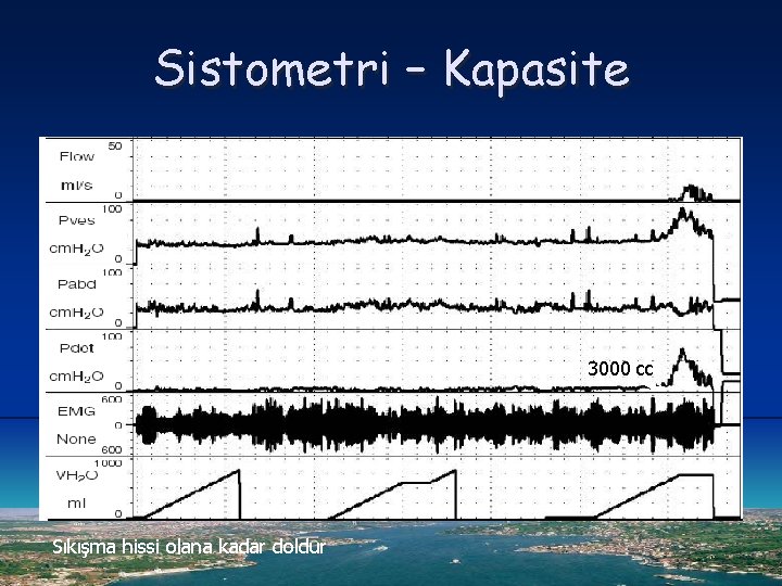 Sistometri – Kapasite 3000 cc Sıkışma hissi olana kadar doldur 