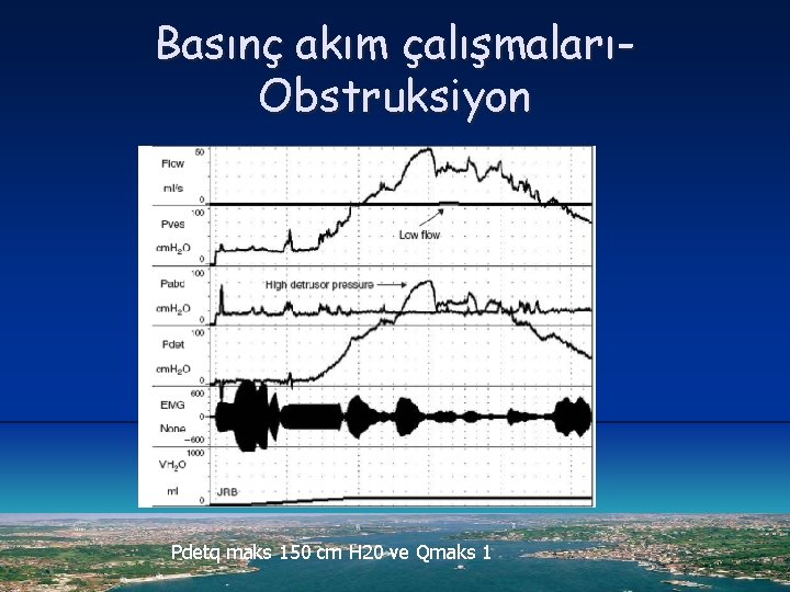 Basınç akım çalışmalarıObstruksiyon Pdetq maks 150 cm H 20 ve Qmaks 1 