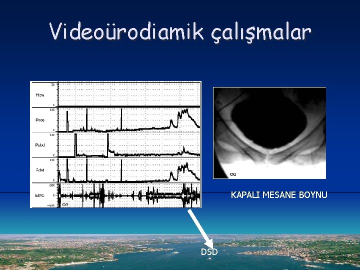 Videoürodiamik çalışmalar KAPALI MESANE BOYNU DSD 