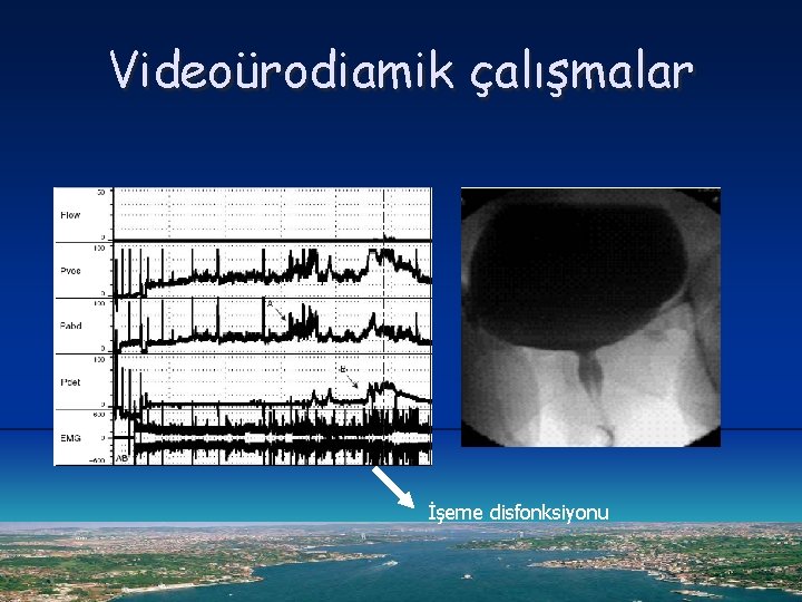 Videoürodiamik çalışmalar İşeme disfonksiyonu 