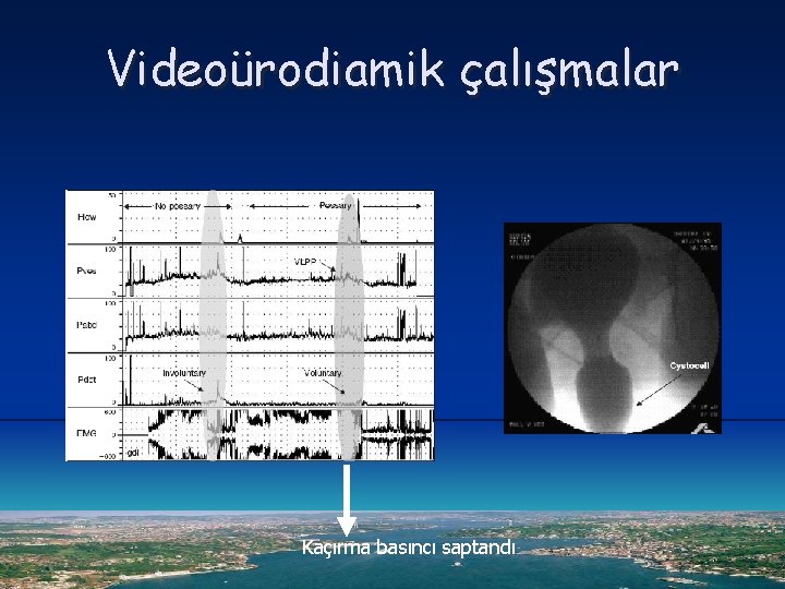 Videoürodiamik çalışmalar Kaçırma basıncı saptandı 