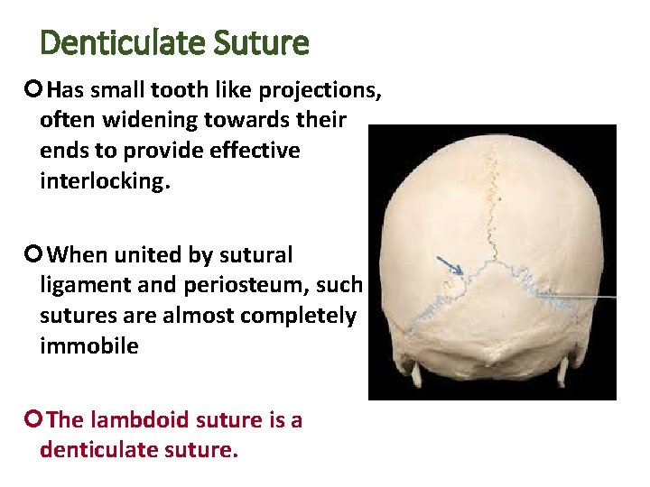 Denticulate Suture Has small tooth like projections, often widening towards their ends to provide Denticulate Suture Has small tooth like projections, often widening towards their ends to provide