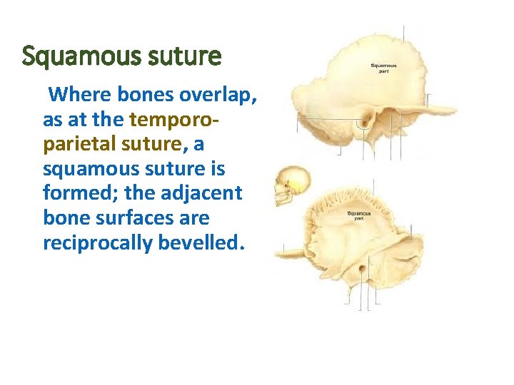 Squamous suture Where bones overlap, as at the temporoparietal suture, suture a squamous suture Squamous suture Where bones overlap, as at the temporoparietal suture, suture a squamous suture