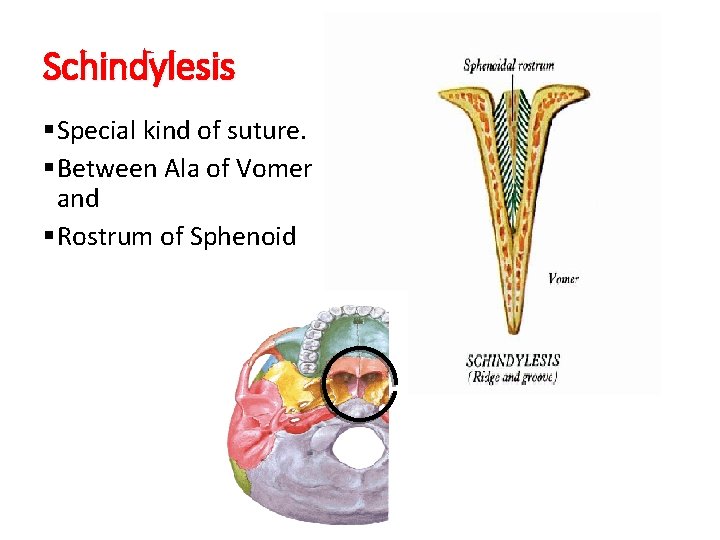 Schindylesis §Special kind of suture. §Between Ala of Vomer and §Rostrum of Sphenoid Schindylesis §Special kind of suture. §Between Ala of Vomer and §Rostrum of Sphenoid