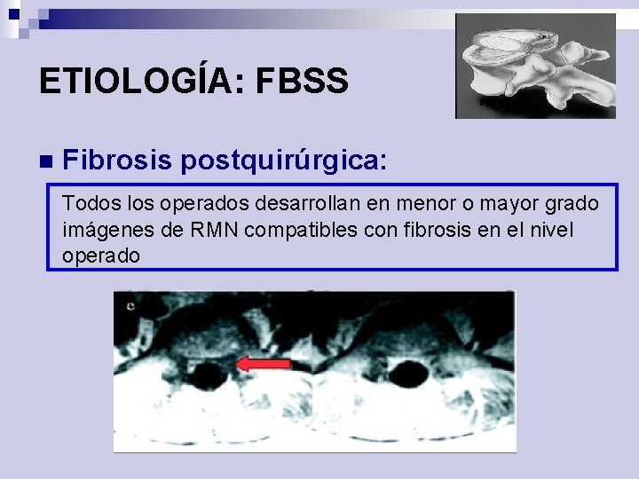 ETIOLOGÍA: FBSS n Fibrosis postquirúrgica: Todos los operados desarrollan en menor o mayor grado