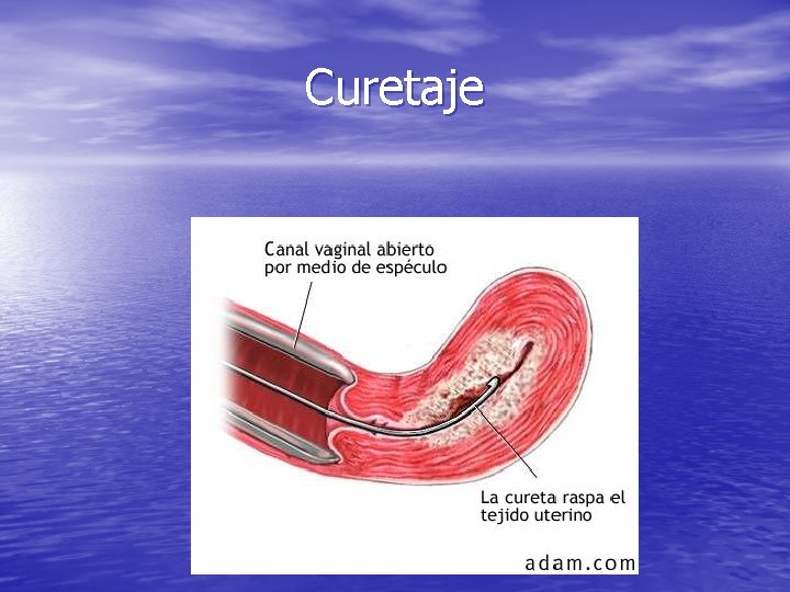 Curetaje 