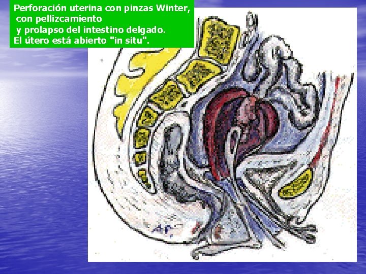 Perforación uterina con pinzas Winter, con pellizcamiento y prolapso del intestino delgado. El útero