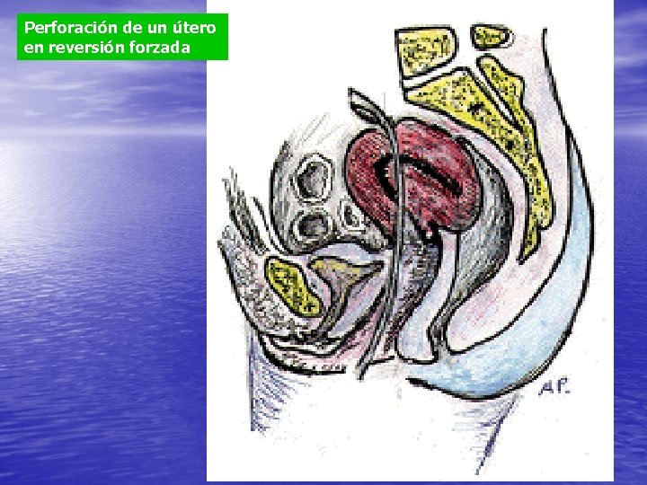 Perforación de un útero en reversión forzada 