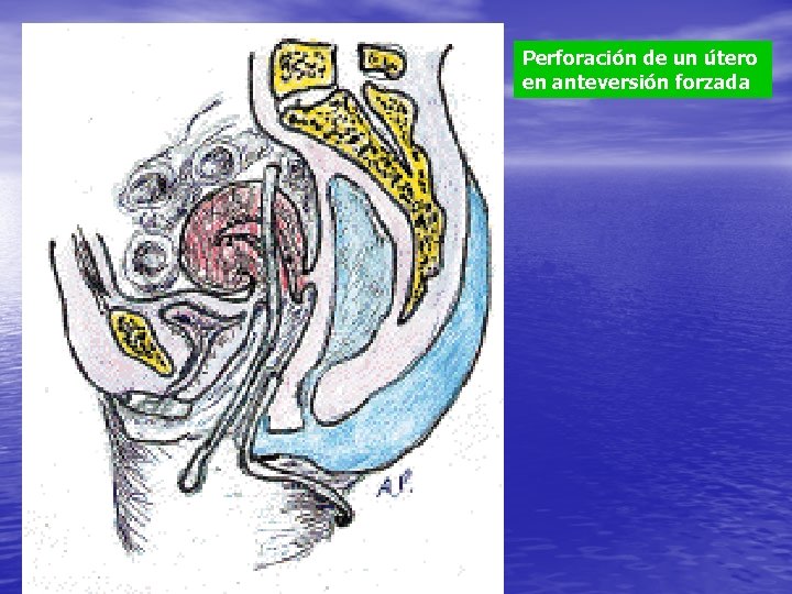 Perforación de un útero en anteversión forzada 