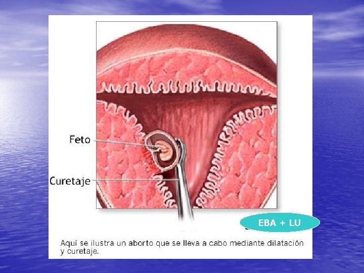 LU EBA + LU 