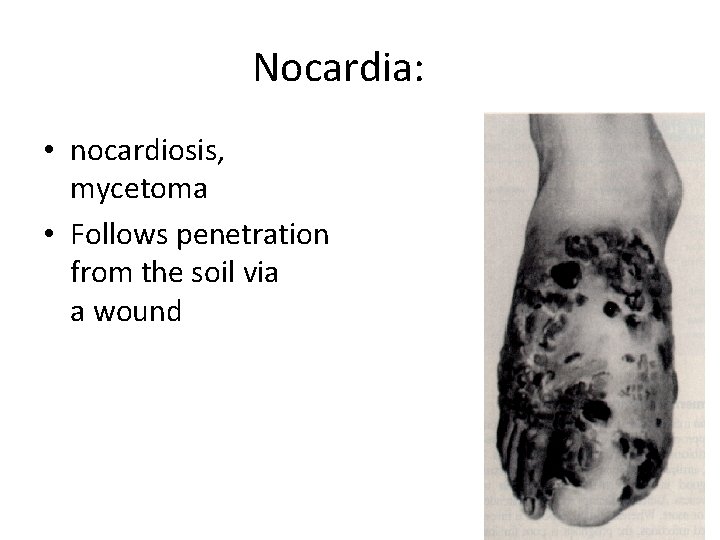 Nocardia: • nocardiosis, mycetoma • Follows penetration from the soil via a wound 