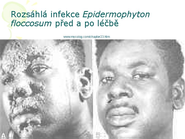 Rozsáhlá infekce Epidermophyton floccosum před a po léčbě www. mycolog. com/chapter 23. htm 