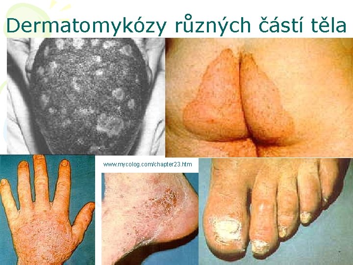 Dermatomykózy různých částí těla www. mycolog. com/chapter 23. htm 