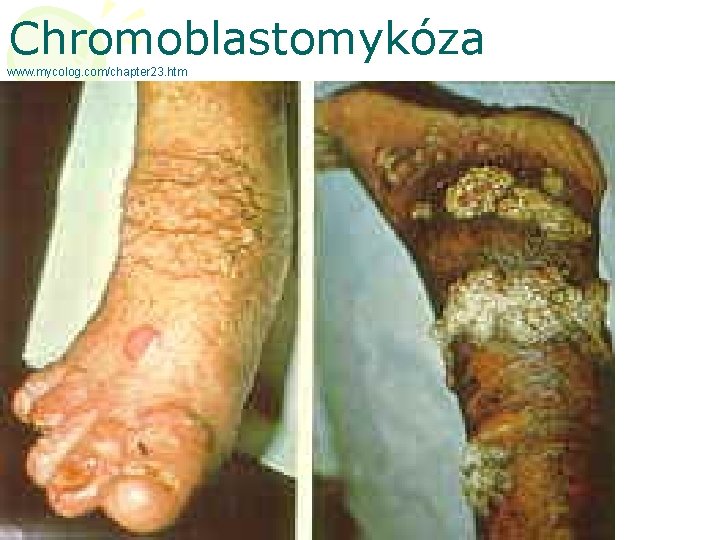 Chromoblastomykóza www. mycolog. com/chapter 23. htm 
