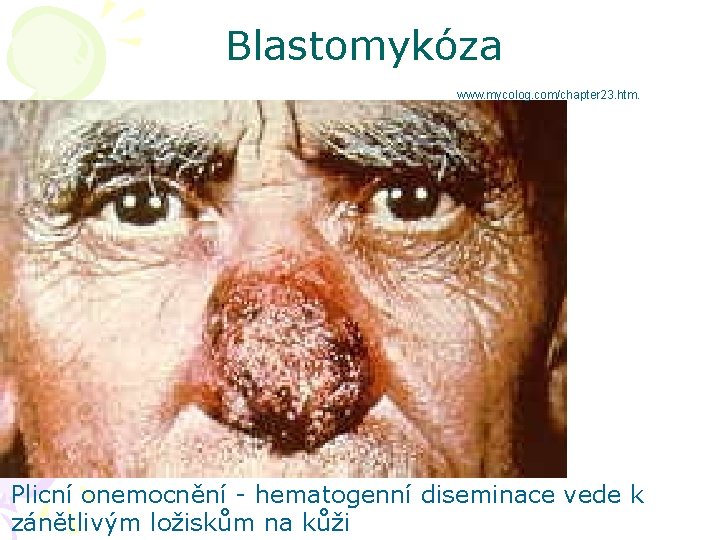 Blastomykóza www. mycolog. com/chapter 23. htm. Plicní onemocnění - hematogenní diseminace vede k zánětlivým