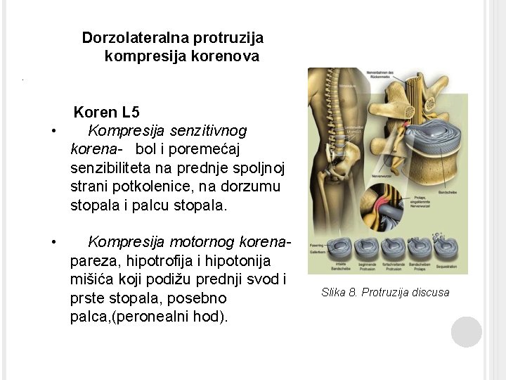 Dorzolateralna protruzija kompresija korenova. Koren L 5 • Kompresija senzitivnog korena- bol i poremećaj