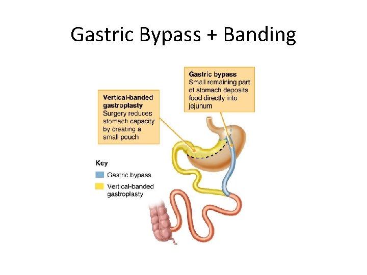 Gastric Bypass + Banding 