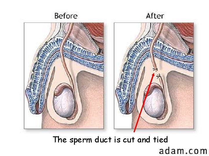 The sperm duct is cut and tied 