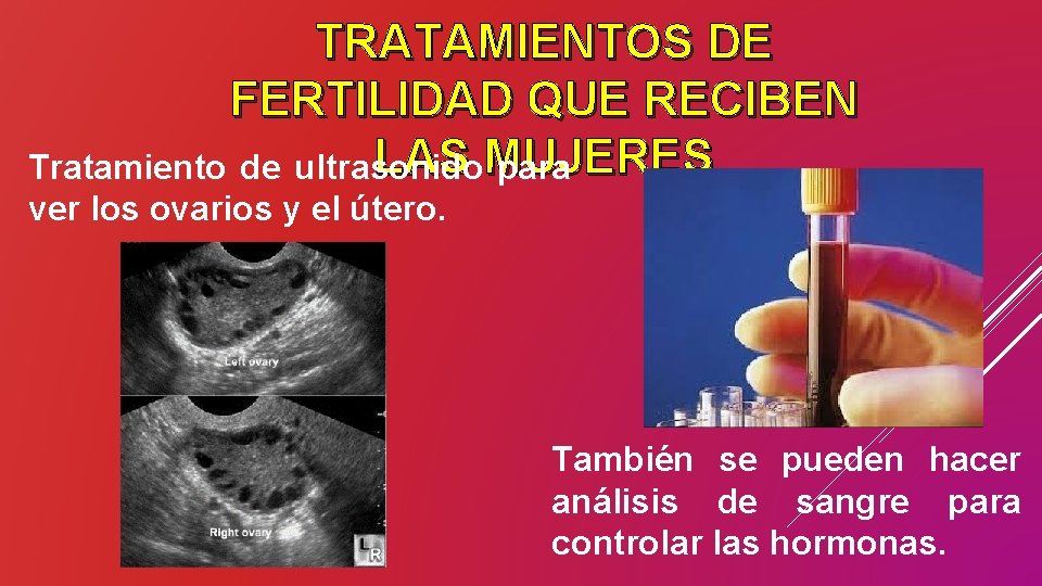 TRATAMIENTOS DE FERTILIDAD QUE RECIBEN LAS MUJERES Tratamiento de ultrasonido para ver los ovarios