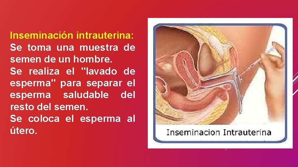 Inseminación intrauterina: Se toma una muestra de semen de un hombre. Se realiza el