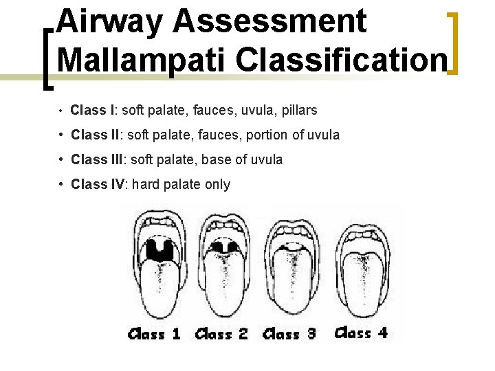 Airway Assessment Mallampati Classification • Class I: soft palate, fauces, uvula, pillars • Class