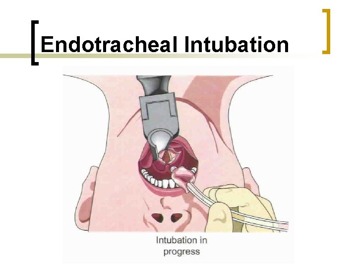 Endotracheal Intubation 