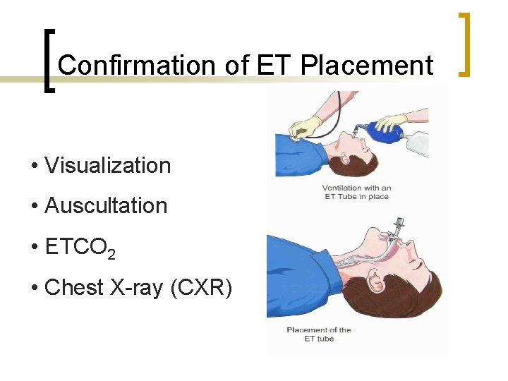 Confirmation of ET Placement • Visualization • Auscultation • ETCO 2 • Chest X-ray