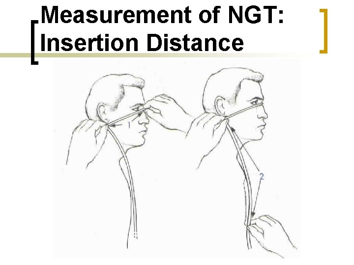 Measurement of NGT: Insertion Distance 