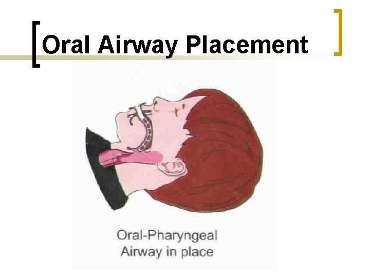 Oral Airway Placement 