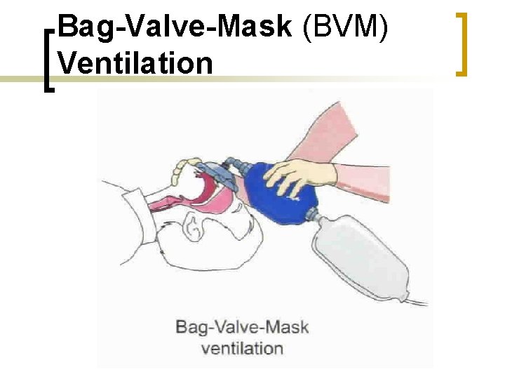 Bag-Valve-Mask (BVM) Ventilation 