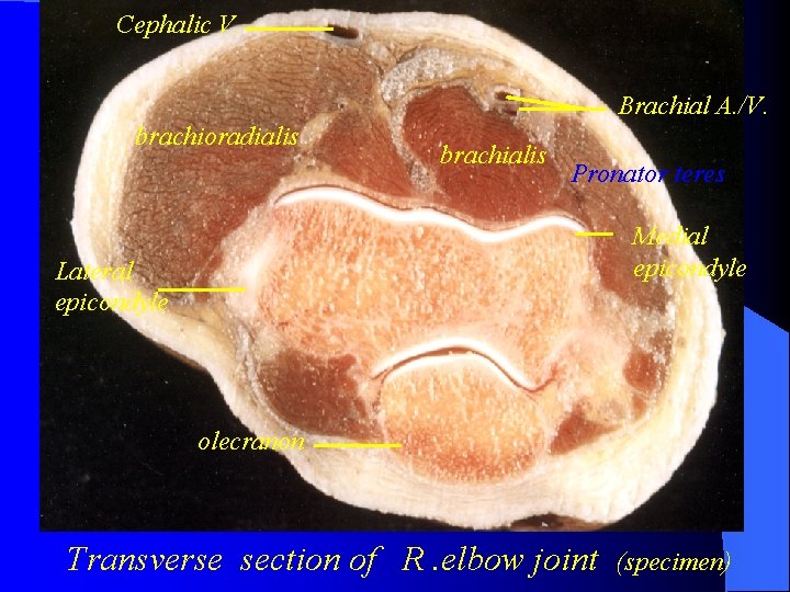 Cephalic V. Brachial A. /V. brachioradialis brachialis Pronator teres Medial epicondyle Lateral epicondyle olecranon