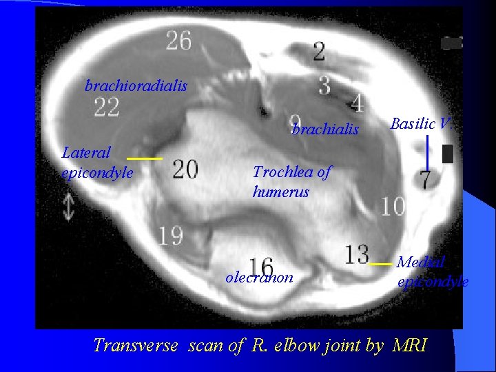 brachioradialis brachialis Lateral epicondyle Basilic V. Trochlea of humerus olecranon Medial epicondyle Transverse scan