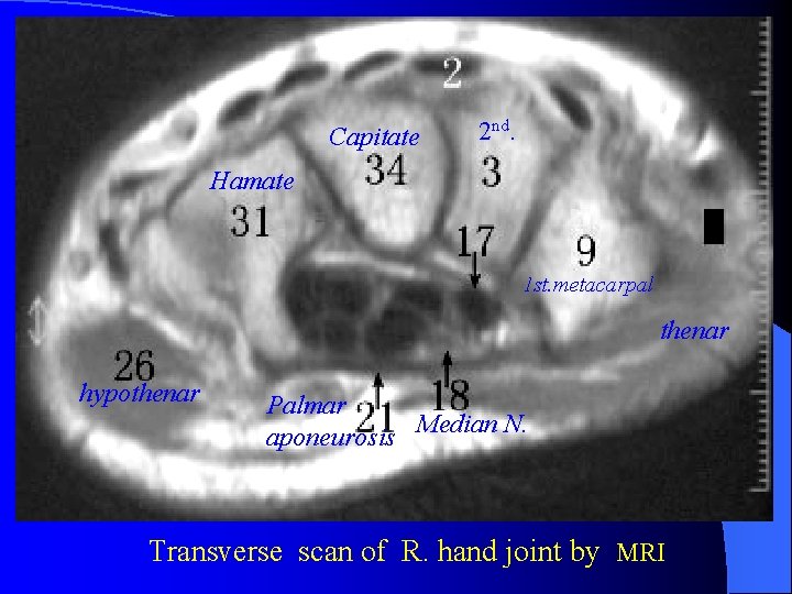 Capitate 2 nd. Hamate 1 st. metacarpal thenar hypothenar Palmar aponeurosis Median N. Transverse