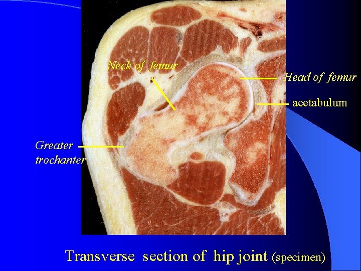 Neck of femur Head of femur acetabulum Greater trochanter Transverse section of hip joint