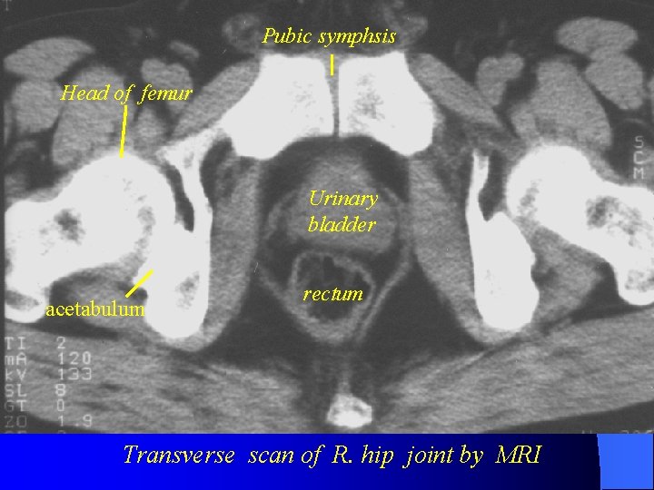 Pubic symphsis Head of femur Urinary bladder acetabulum rectum Transverse scan of R. hip
