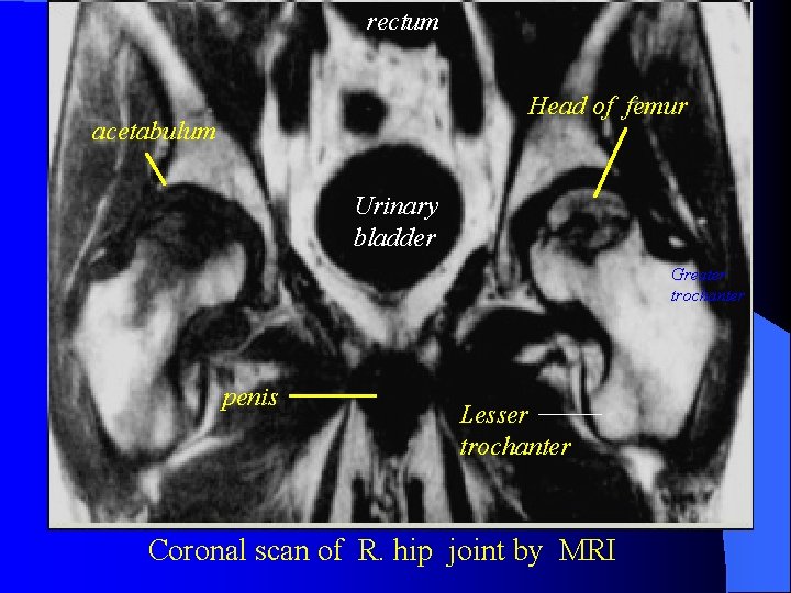 rectum Head of femur acetabulum Urinary bladder Greater trochanter penis Lesser trochanter Coronal scan