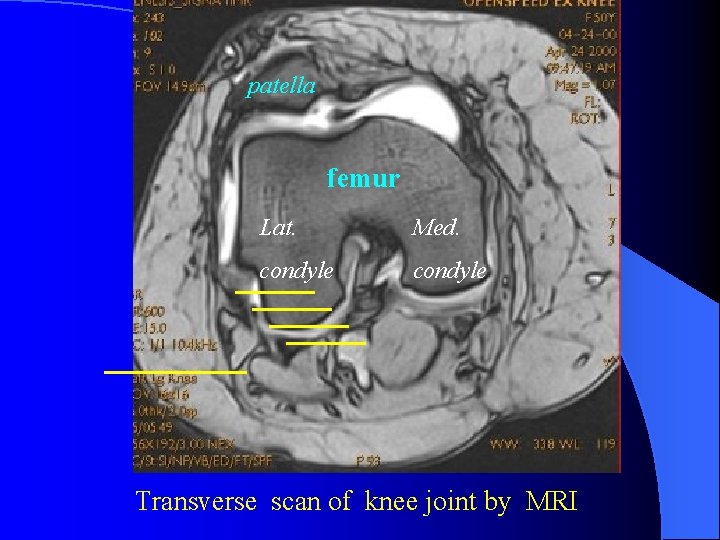 patella femur Lat. Med. condyle Transverse scan of knee joint by MRI 