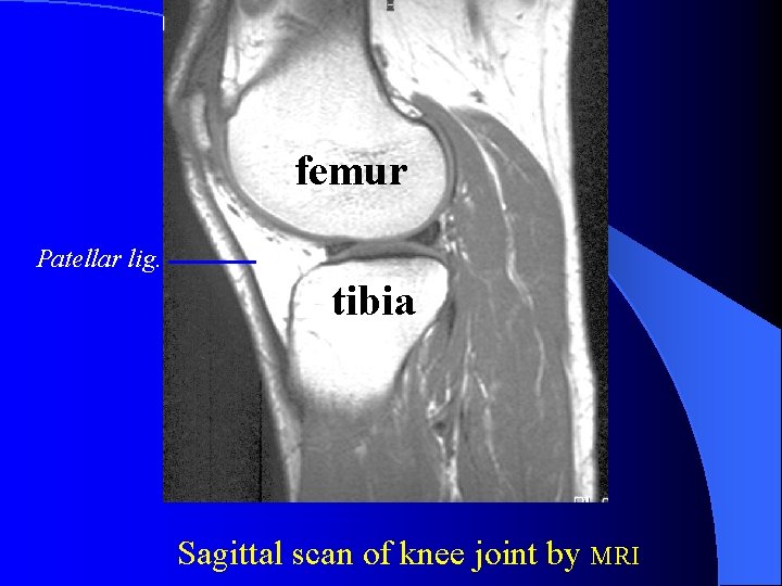 femur Patellar lig. tibia Sagittal scan of knee joint by MRI 