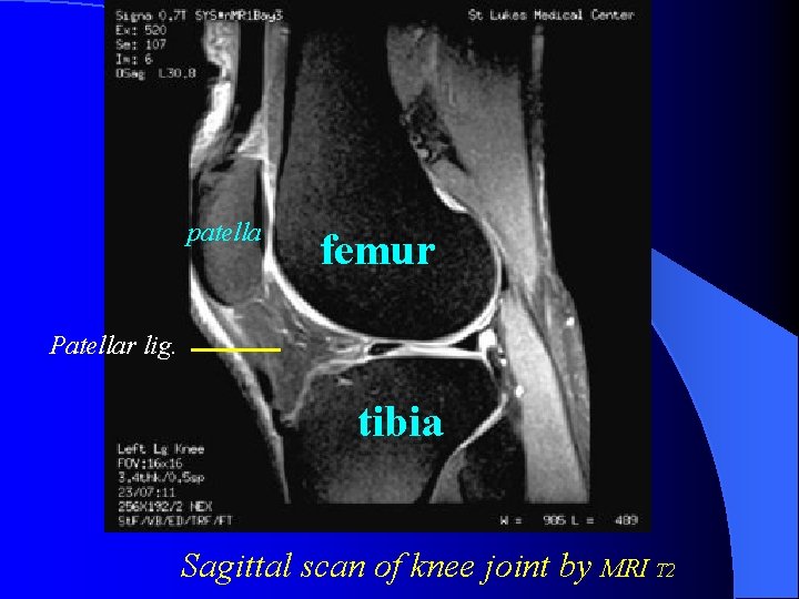patella femur Patellar lig. tibia Sagittal scan of knee joint by MRI T 2