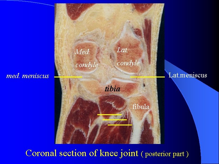 Med. Lat. condyle Lat. meniscus med. meniscus tibia fibula Coronal section of knee joint