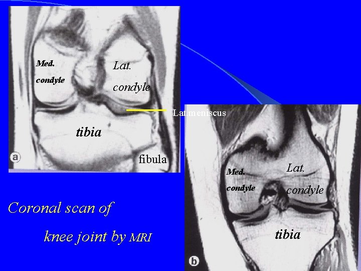 Med. Lat. condyle Lat. meniscus tibia fibula Med. Lat. condyle Coronal scan of knee