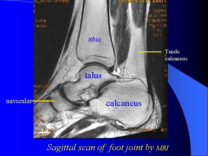 tibia Tendo calcaneus talus navicular calcaneus Sagittal scan of foot joint by MRI 