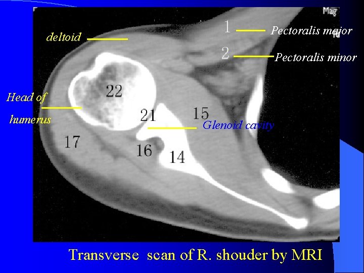 deltoid Pectoralis major Pectoralis minor Head of humerus Glenoid cavity Transverse scan of R.